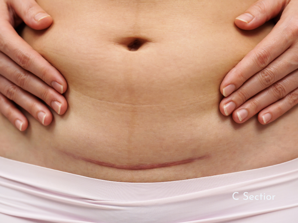 How Scars Block Lymphatic Flow and What You Can Do About It
