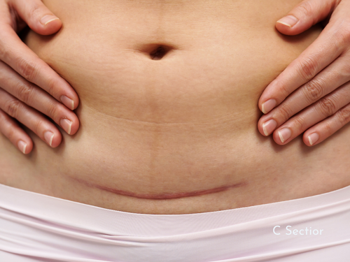 How Scars Block Lymphatic Flow and What You Can Do About It