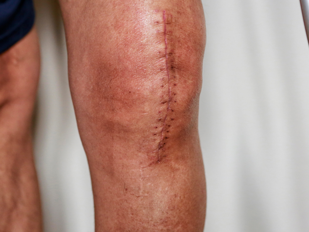 Why Scars can Feel Tight and Why Movement Matters