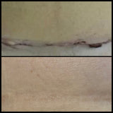 Myscar Premium Silicone Strips